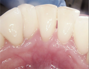 Tooth Staining after picture once it has been removed by they hygienist