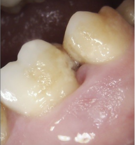 Plaque build up in between teeth that have not been flossed