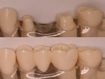 Missing teeth replaced with a fixed bridge