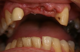 Picture of some missing front teeth