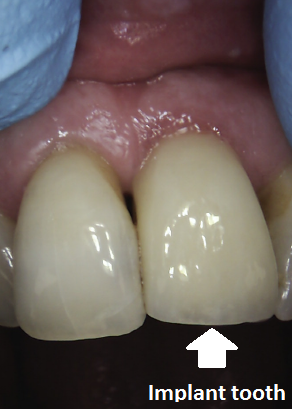 Picture of the same implant but in the mouth replacing the missing tooth