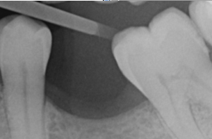 X-ray showing resorption and drifiting that can be caused by not replacing missing teeth