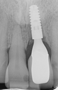 X-ray image of in implant replacing a missing tooth showing the screw in the jaw bone