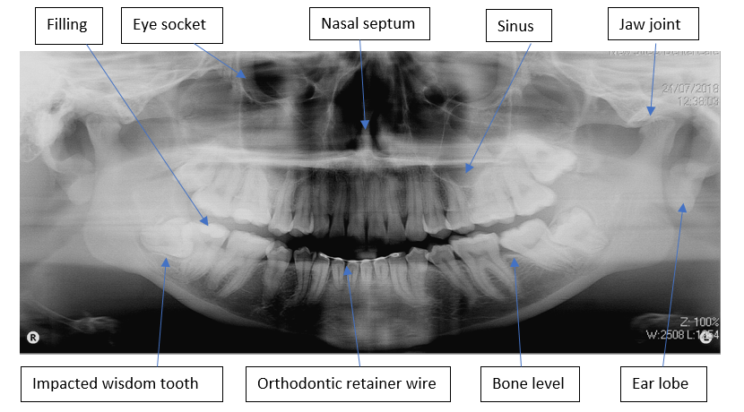 OPG x-ray showing the top and bottom jaw well as some other anatomy such as the ear lobes