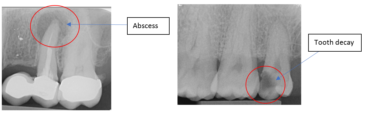 Labelled x-ray to show an abscess and tooth decay