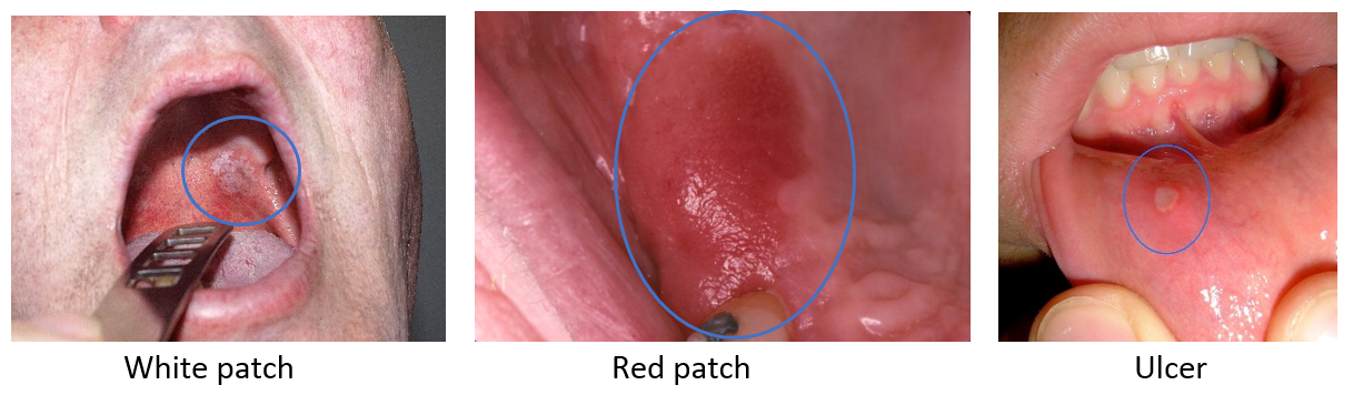 Signs of mouth cancer Red and White Patches and Ulcers