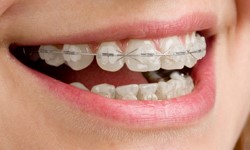 What ceramic fixed braces look like