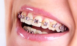 What traditional fixed braces look like