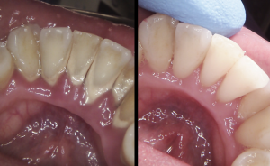 Before and after picture to show the removal of tartar