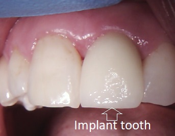 Picture of the same implant as the x-ray