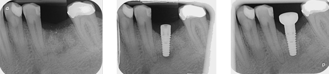 X-rays to show the progression of implant placement