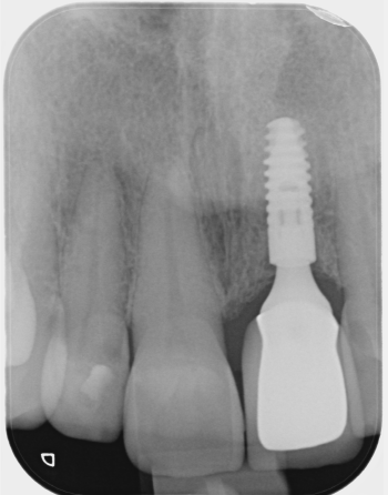 X-ray of a dental implant placed 